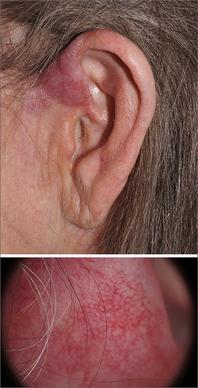 lymphoma behind ear
