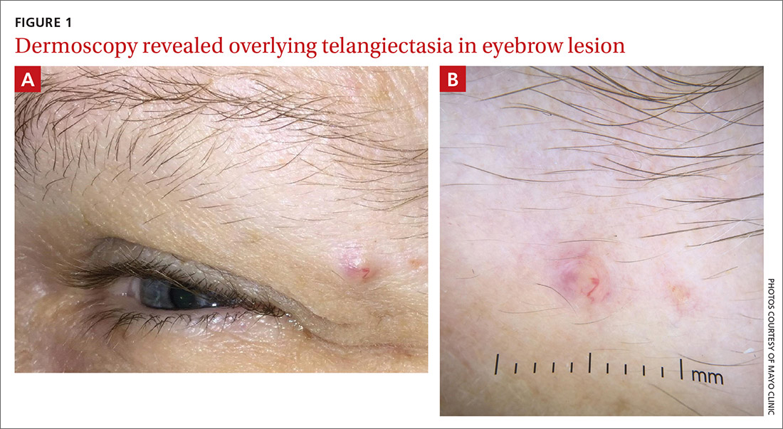 Overlying telangiectasia in eyebrow lesion