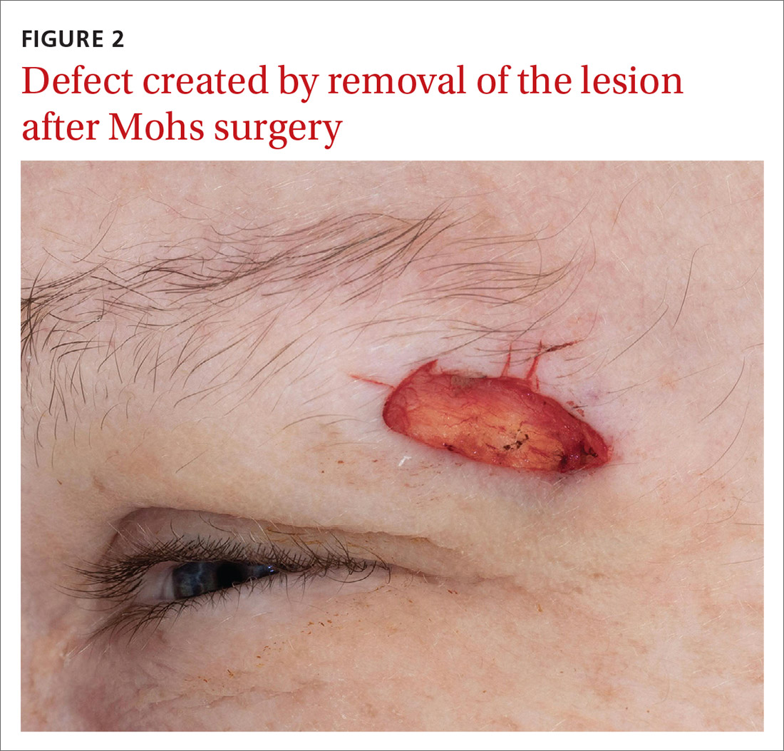 Defect created by removal of the lesion after Mohs surgery