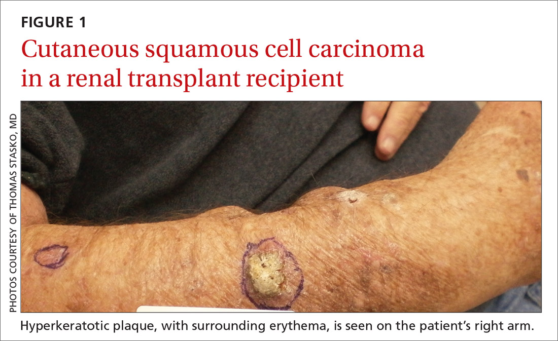 Cutaneous squamous cell carcinoma in a renal transplant recipient