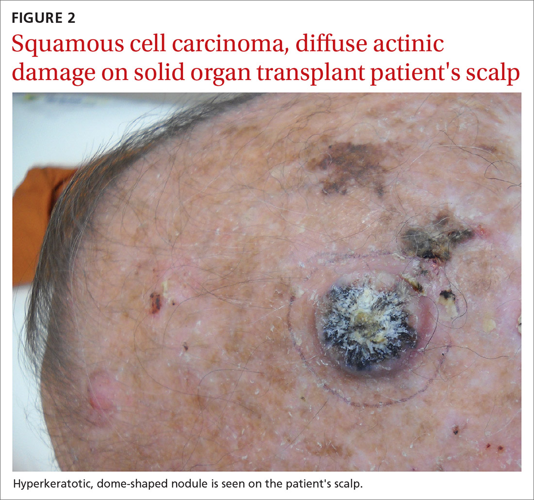 Squamous cell carcinoma, diffuse actinic damage on solid organ transplant patient's scalp