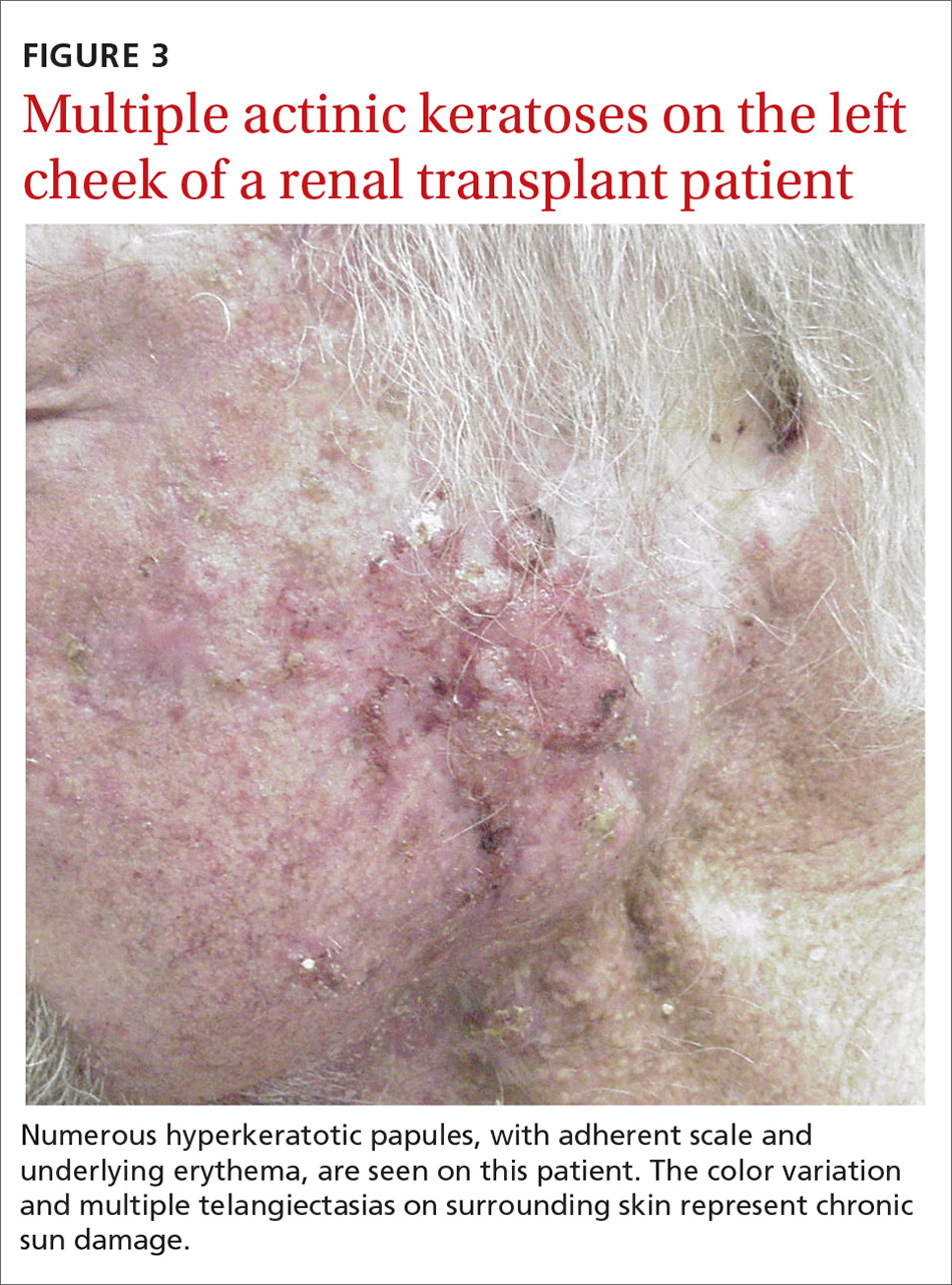 Multiple actinic keratoses on the left cheek of a renal transplant patient