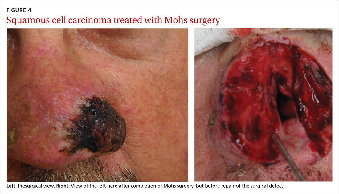 Squamous cell carcinoma treated with Mohs surgery