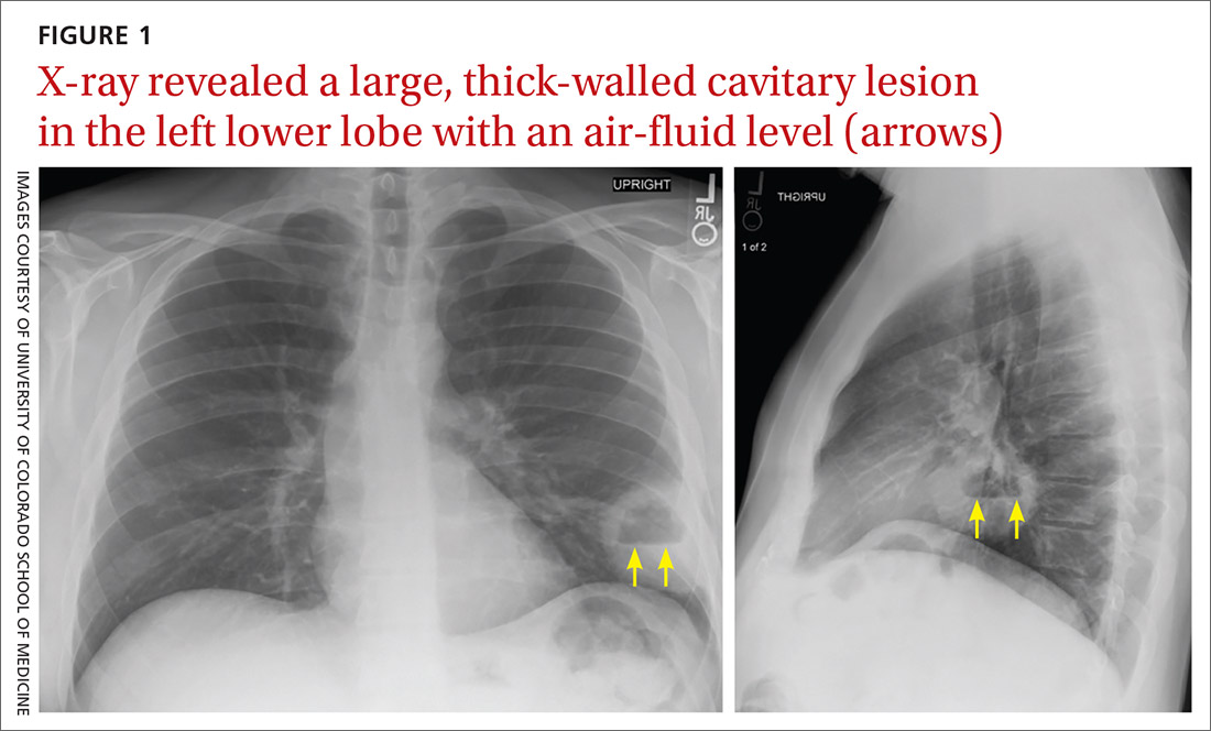 X-ray revealed a large, thick-walled cavitary lesion in the left lower lobe with an air-fluid level