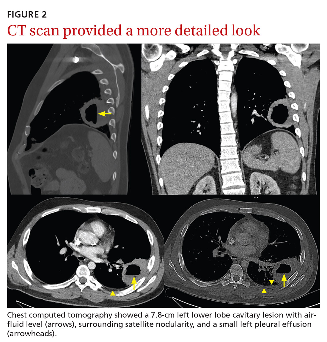 CT scan provided a more detailed look