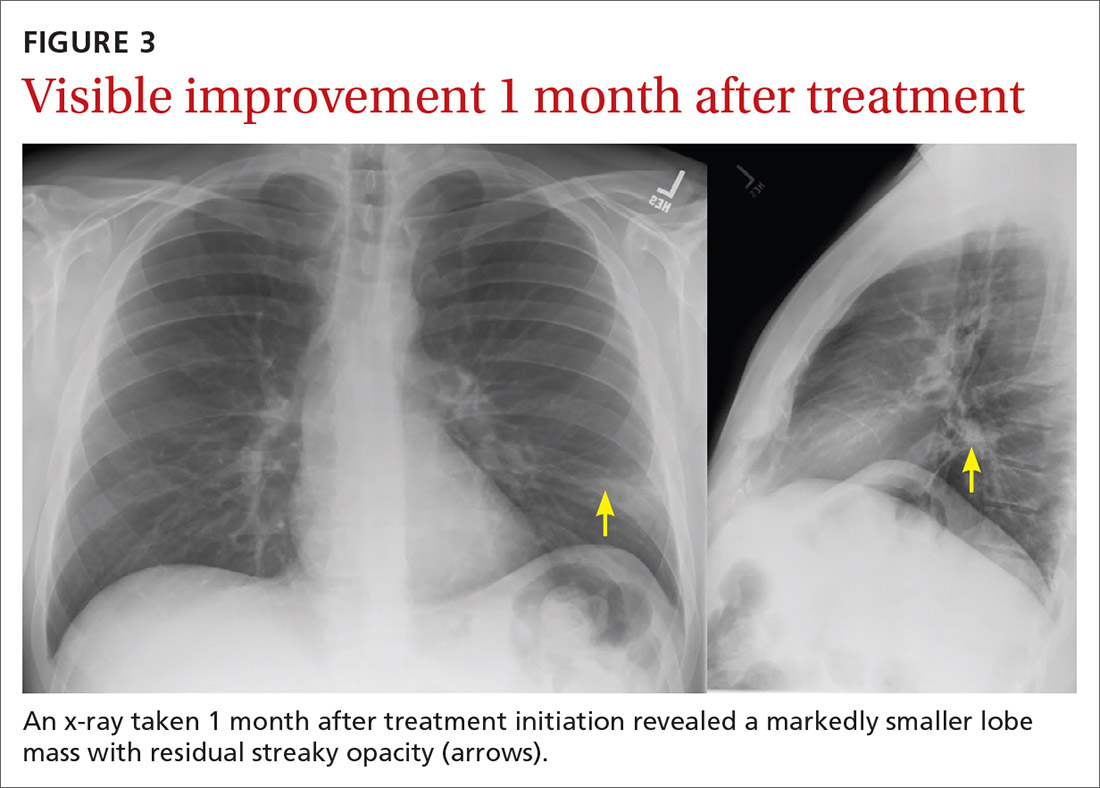 Visible improvement 1 month after treatment