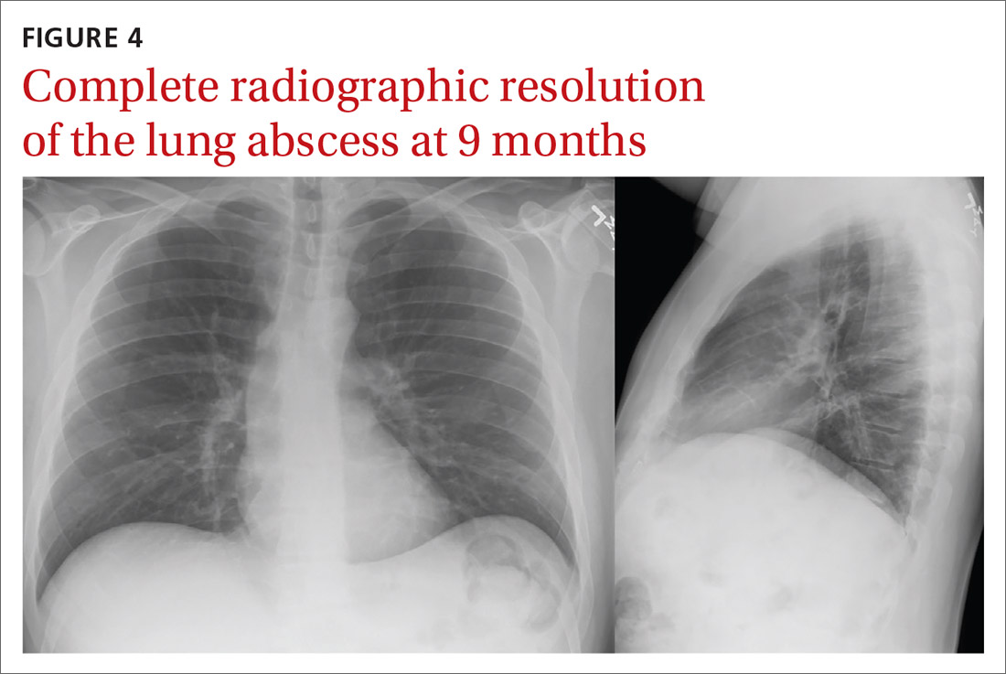 Complete radiographic resolution of the lung abscess at 9 months