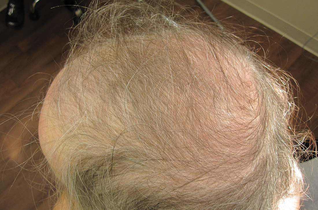 Virilization with male-pattern balding