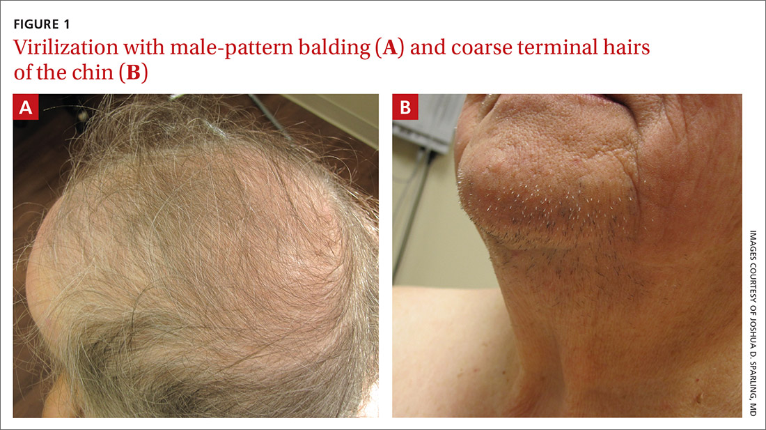 Virilization with male-pattern balding and coarse terminal hairs of the chin