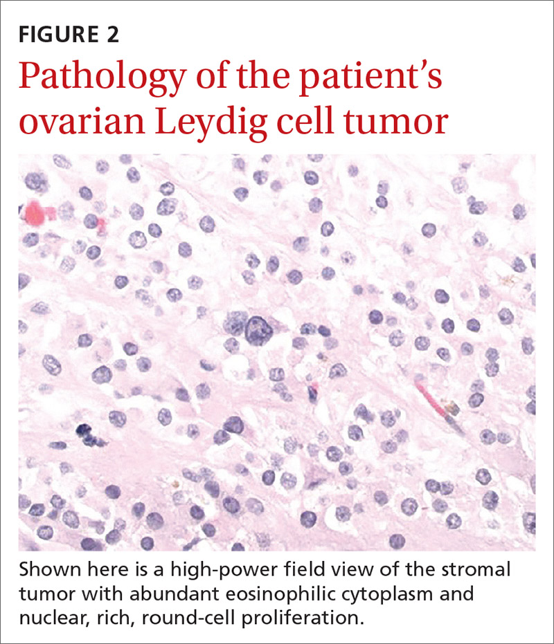 Pathology of the patient’s ovarian Leydig cell tumor