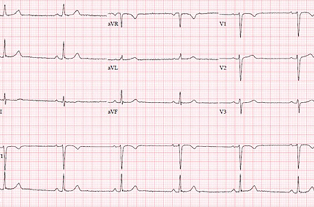 Sinus bradycardia EKG