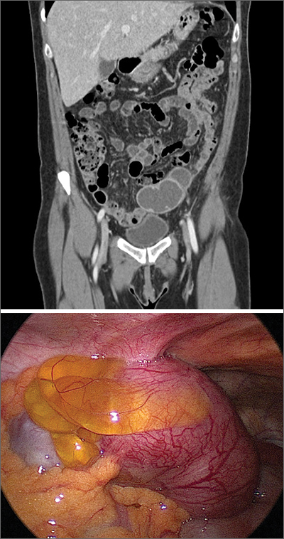 Adnexal mass