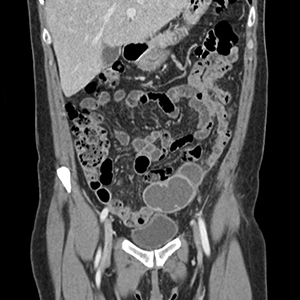 Adnexal mass