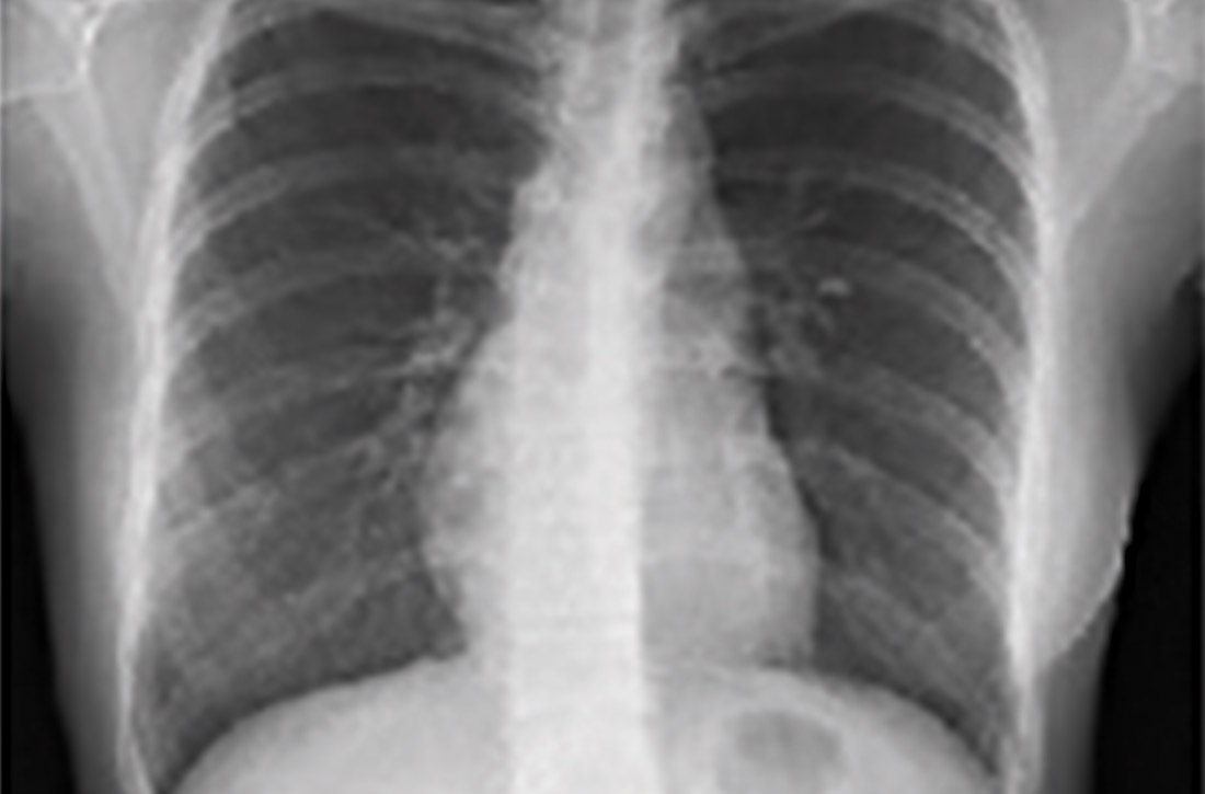 Sarcoidosis on chest x-ray