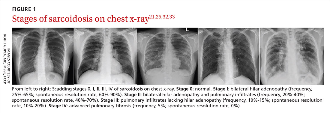 Stages of sarcoidosis on chest x-ray