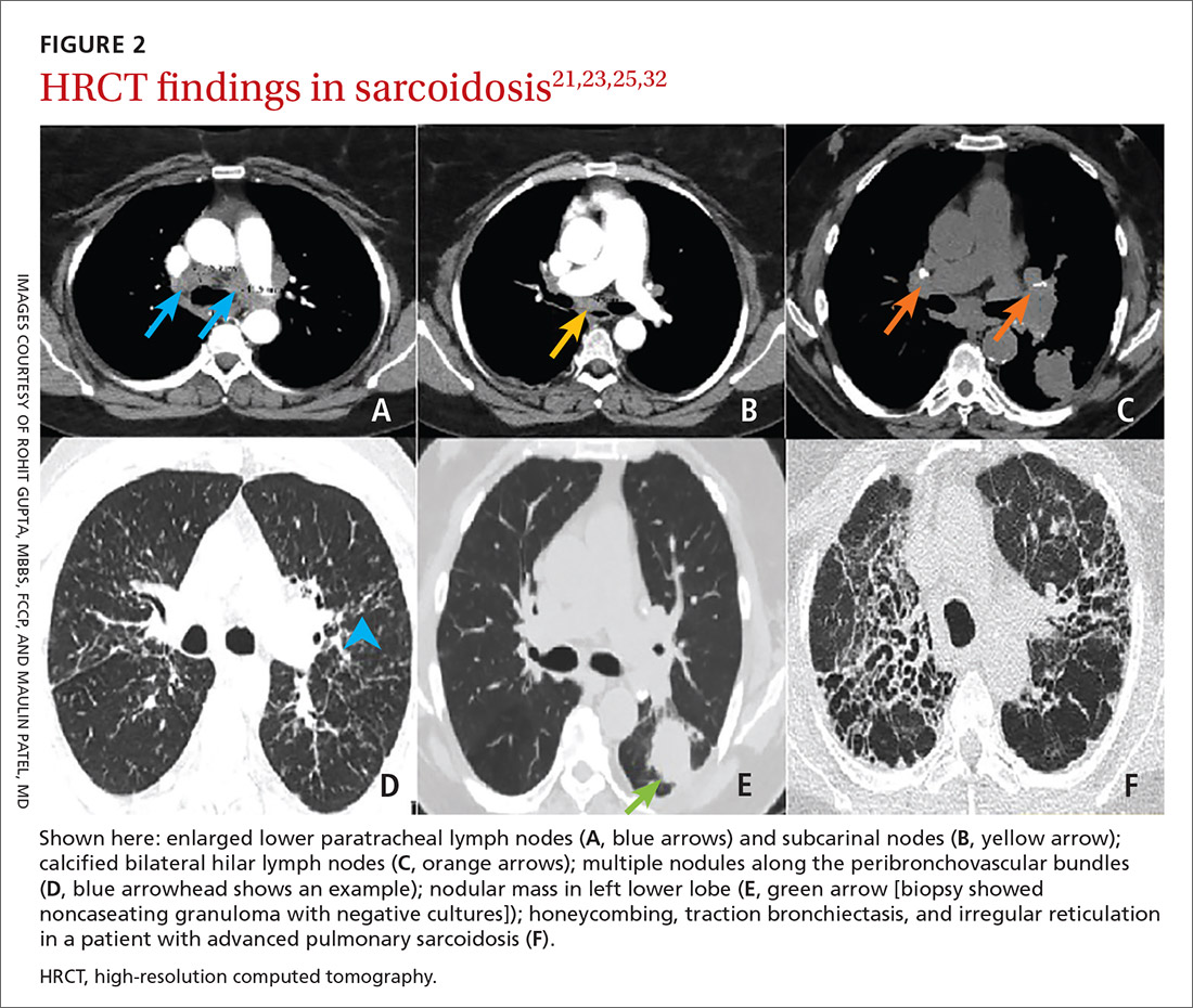 HRCT findings in sarcoidosis