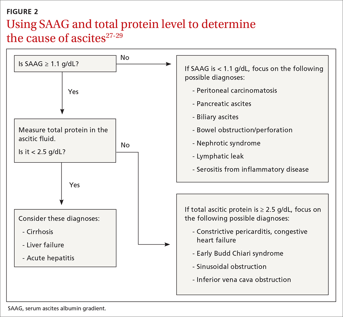 A guide to diagnosing and managing ascites in cirrhosis | MDedge