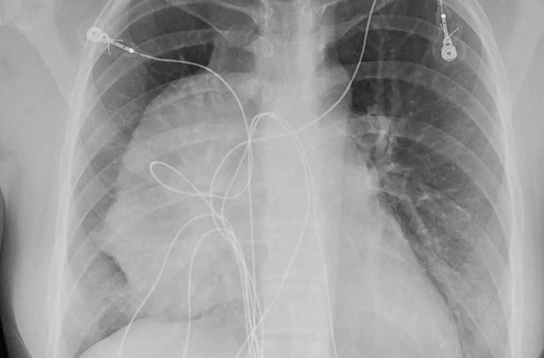 Large mass in the mediastinum