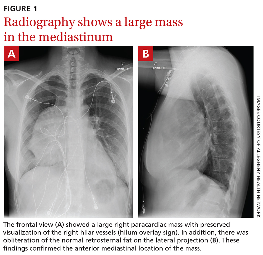 Radiography shows a large mass in the mediastinum