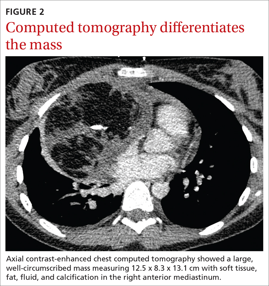 Computed tomography differentiates the mass