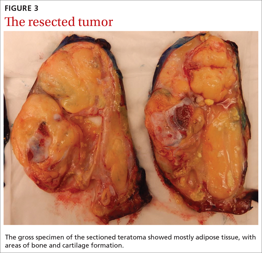 The resected tumor