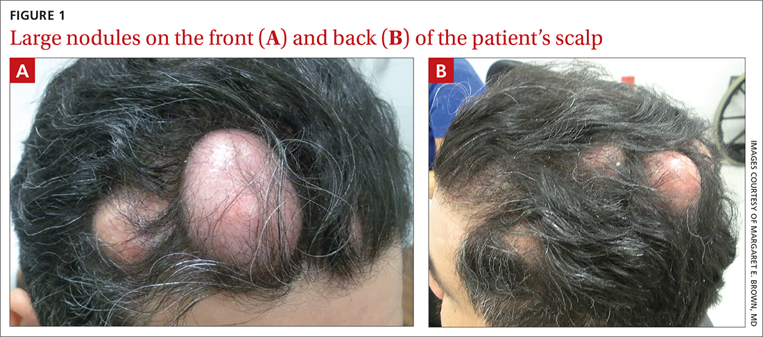 Large nodules on the front and back of the patient’s scalp