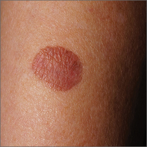 Brown plaque on the arm