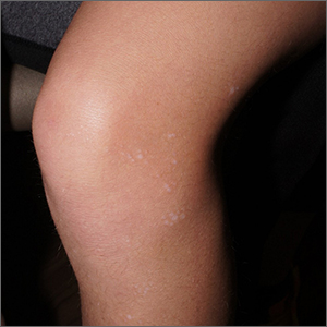 White macules on knee