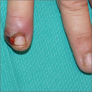 Ingrown nail