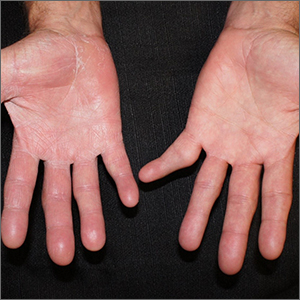 Scaly patches on hands