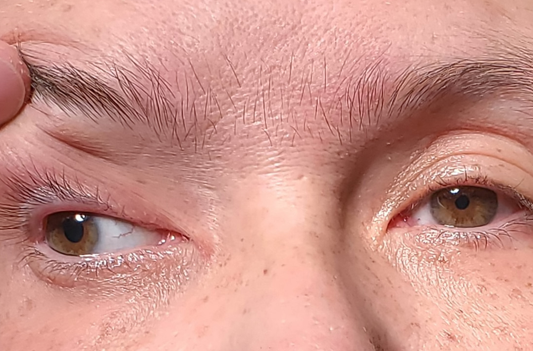 Patient’s gaze when the right eyelid was lifted manually