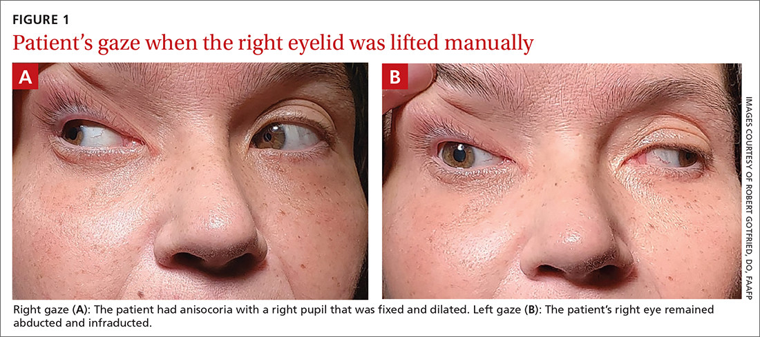 Patient’s gaze when the right eyelid was lifted manually