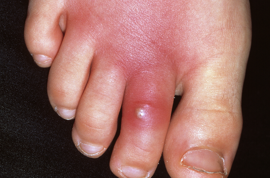 Cellulitis