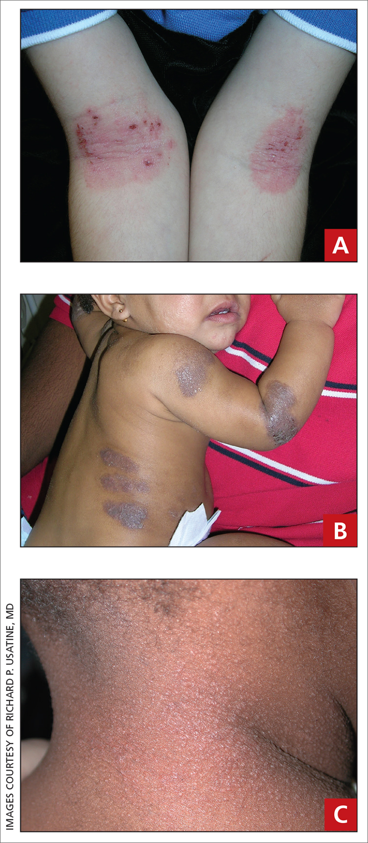 Atopic dermatitis