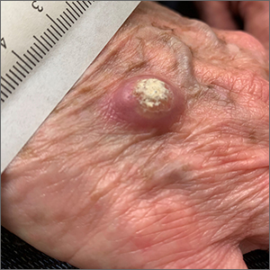 Hand nodule