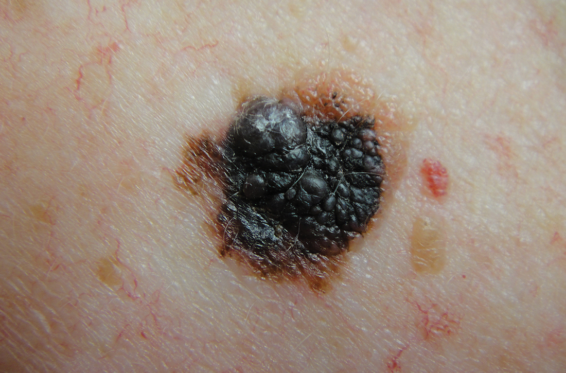 Asymmetric nodular melanoma