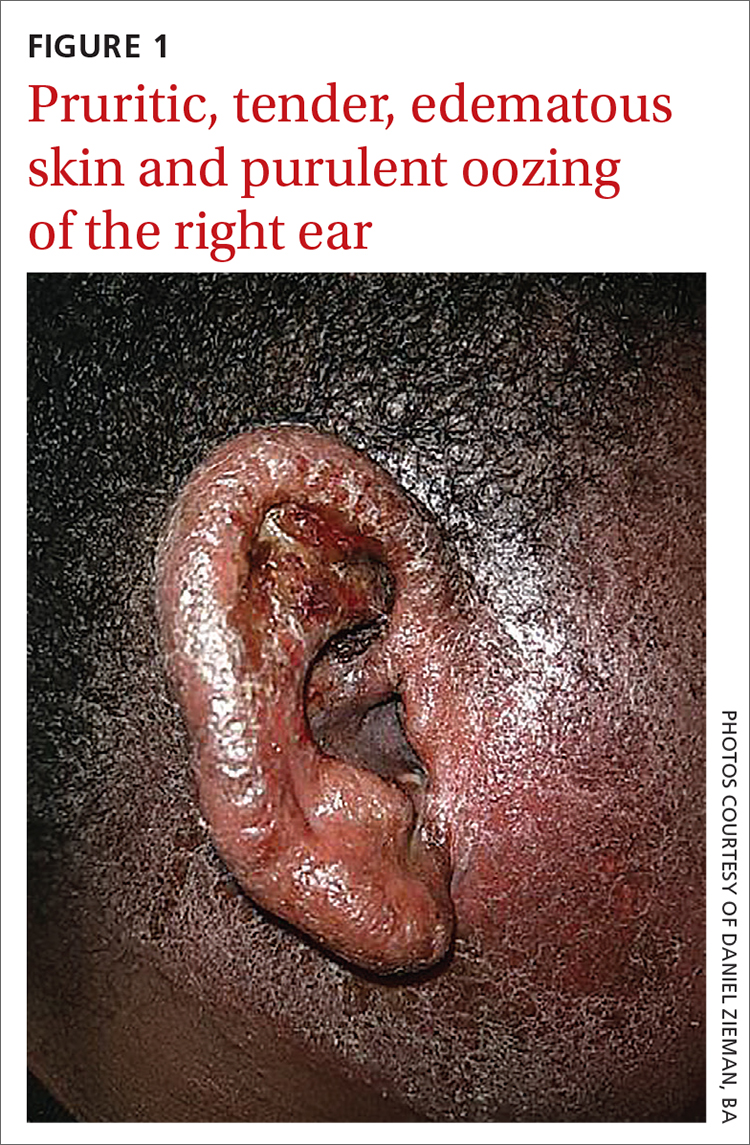 Pruritic, tender, edematous skin and purulent oozing of the right ear