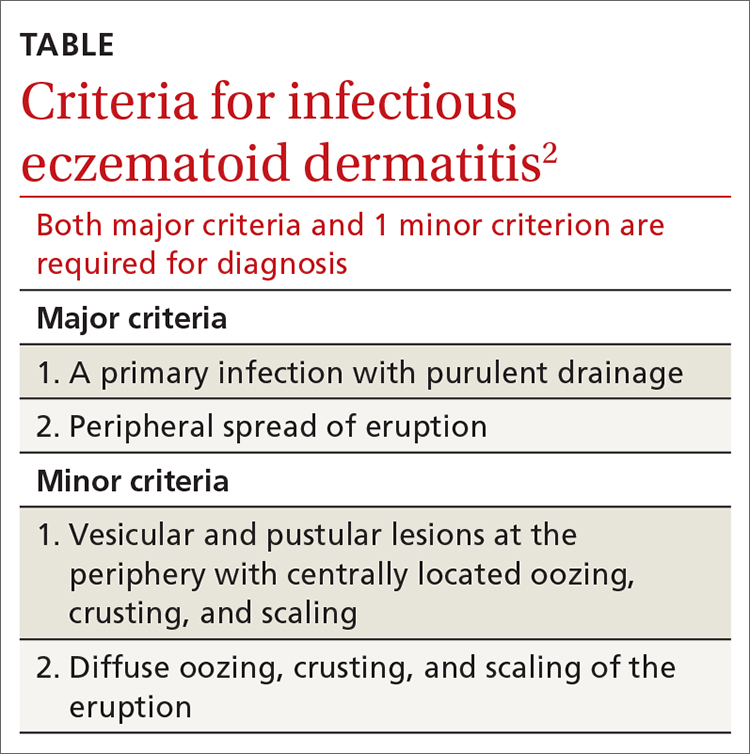 Criteria for infectious eczematoid dermatitis