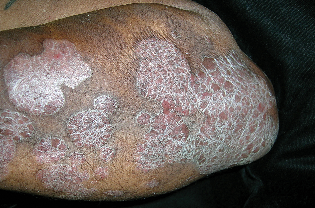 Elbow and forearm with violaceous, well-demarcated plaques with micaceous scale and hyperpigmented patches around the active plaques in a 58-year-old Black man