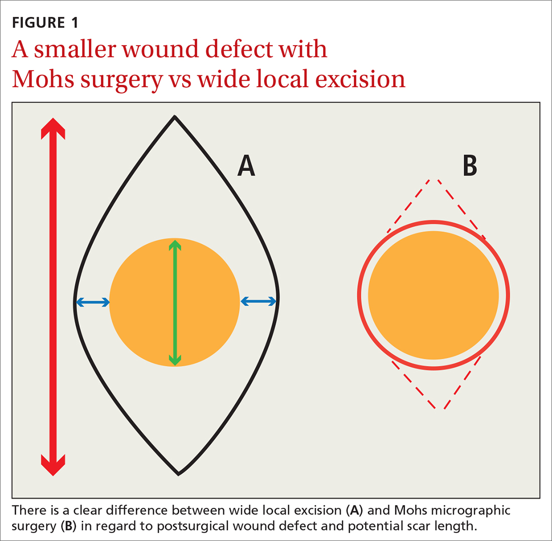 A smaller wound defect with Mohs surgery vs wide local excision