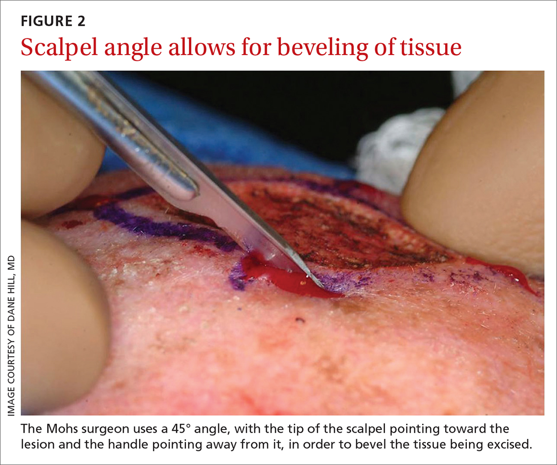 Scalpel angle allows for beveling of tissue