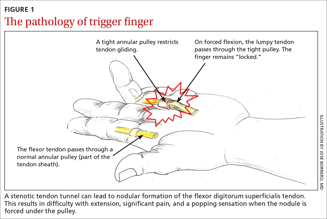 Omgekeerd Classificatie enkel Recognizing and treating trigger finger | MDedge Family Medicine