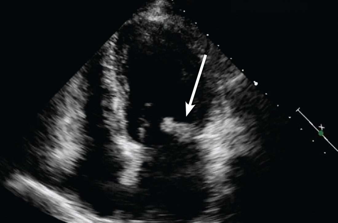 Transthoracic echocardiogram reveals large mass on mitral valve