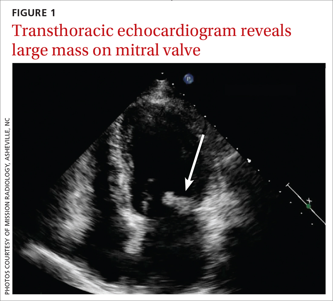 Transthoracic echocardiogram reveals large mass on mitral valve