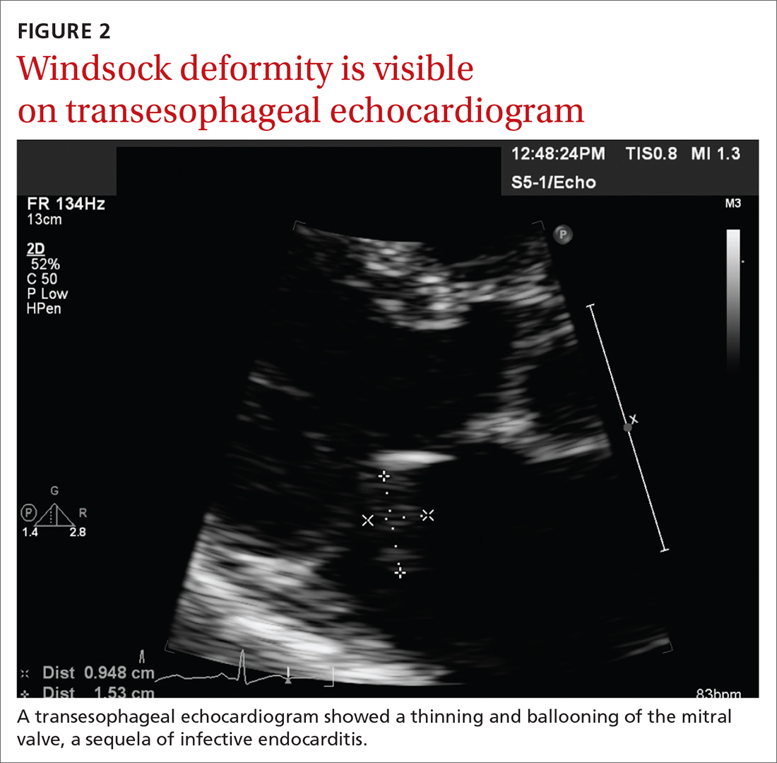 Windsock deformity is visible on transesophageal echocardiogram