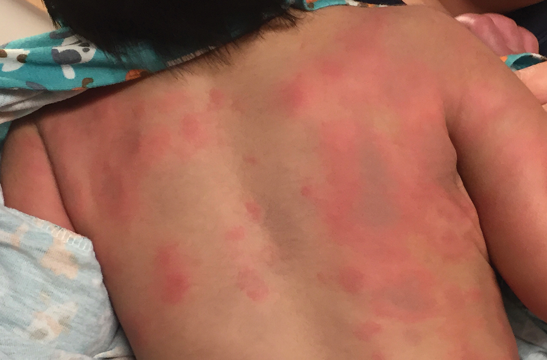 Toddler with back lesions