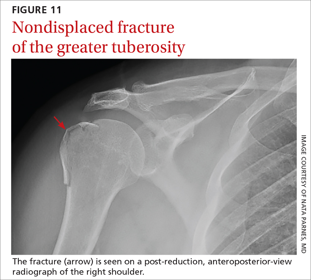 Nondisplaced fracture of the greater tuberosity