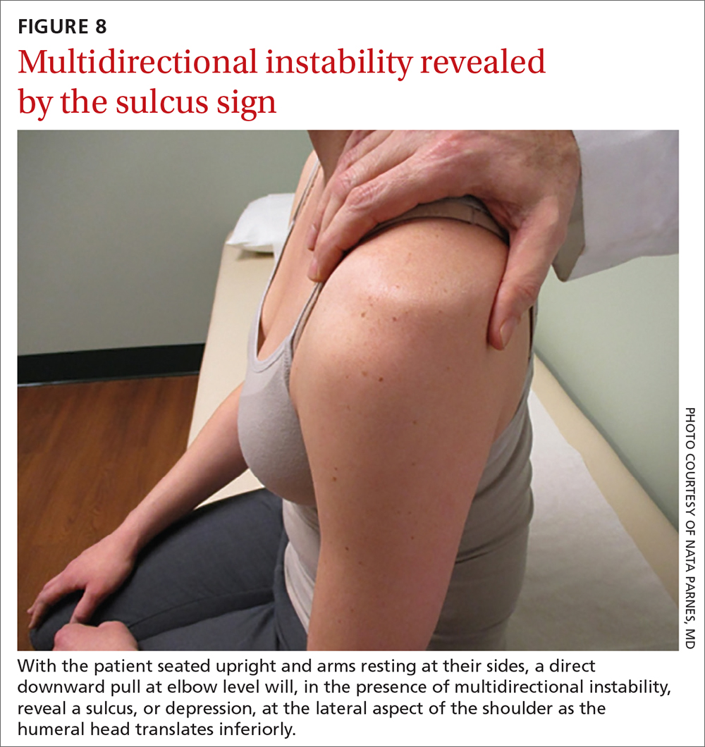 Multidirectional instability revealed by the sulcus sign