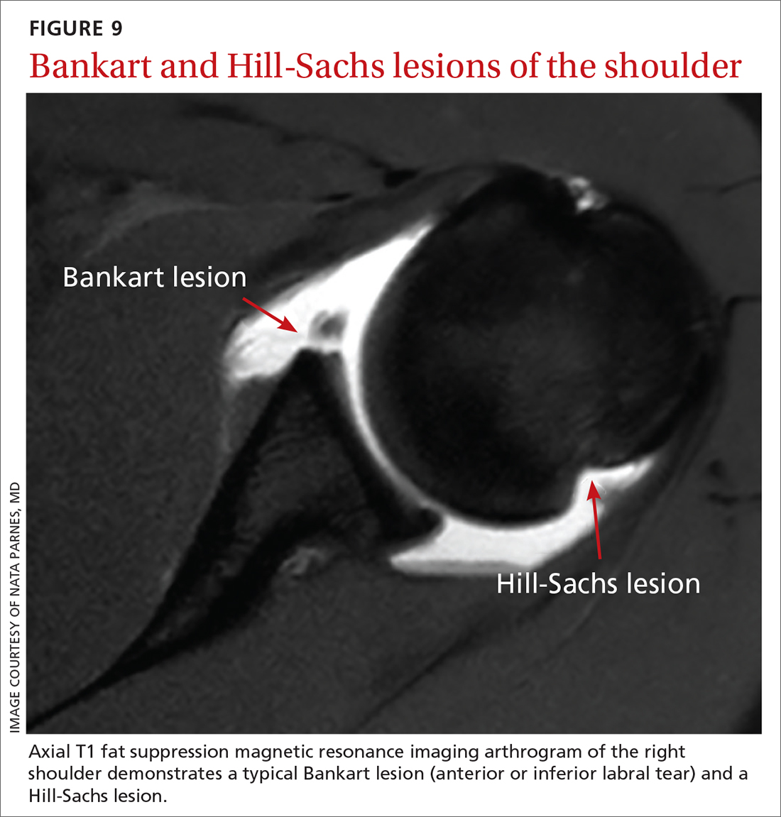 Bankart and Hill-Sachs lesions of the shoulder