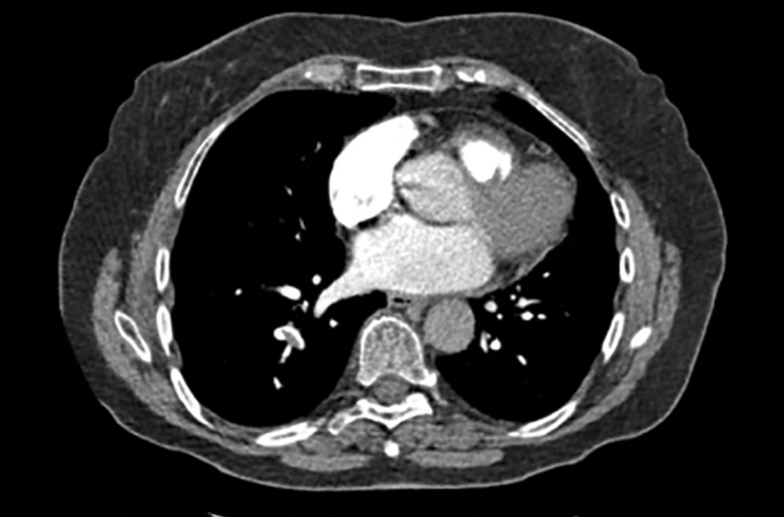 A computed tomography pulmonary angiogram